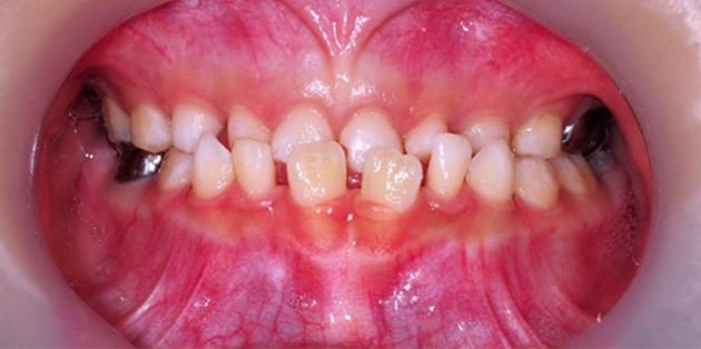 어린이 부정교합의 증상