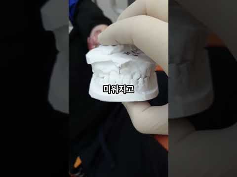 양악수술 해야 한다던 반대교합, 단 4개월 만에 정상교합