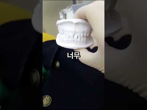 거꾸로 물리던 아이 치아, 아프지 않고 한 달 만에 정상으로?