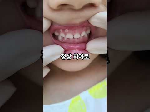 5세~10세 엄마 필수 시청! 우리 아이 주걱턱..