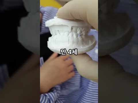 만 4세 반대교합 프랑켈 치료 후기