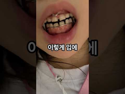 5세~10세 교정 골든타임! 프랑켈 장치 전,후 비교하세요.